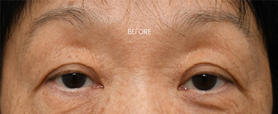 eyelid surgery manhattan