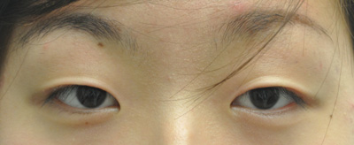 asian blepharoplasty nyc