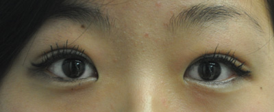 asian blepharoplasty nyc